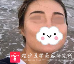 面部提升术