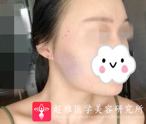 面部提升术
