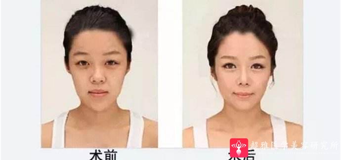 面部提升术
