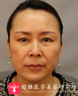 面部提升术