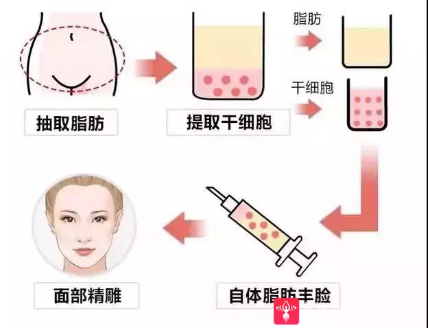 自体脂肪填充术