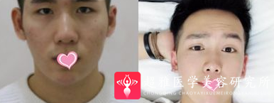 自体脂肪填充术