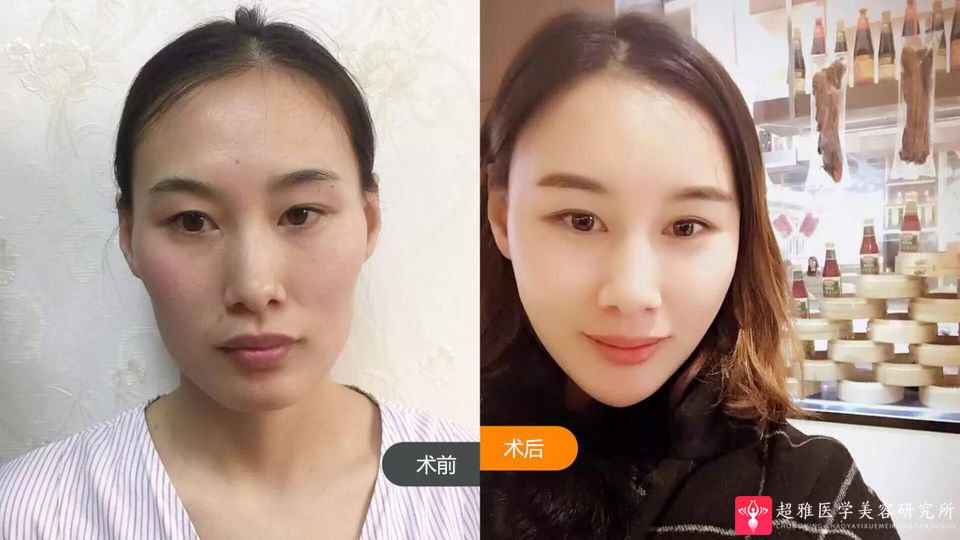 自体脂肪填充术