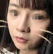 不开刀隆鼻
