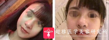 不开刀隆鼻