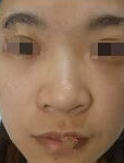 不开刀隆鼻