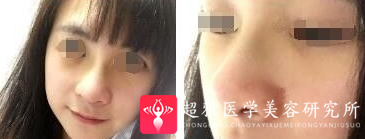 不开刀隆鼻