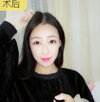 面部提升术