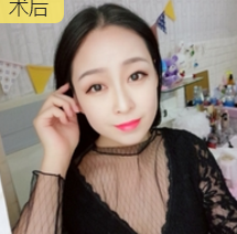 面部提升术