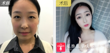 面部提升术