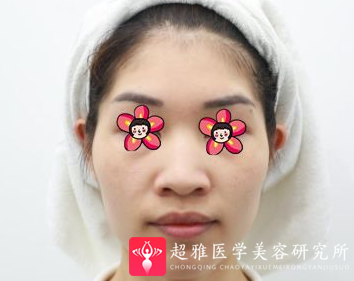 自体脂肪填充术
