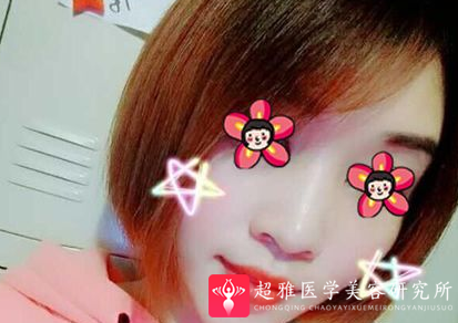 自体脂肪填充术