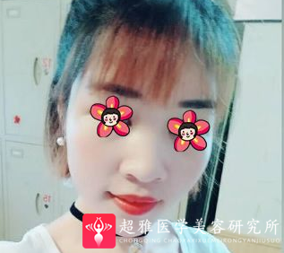 自体脂肪填充术