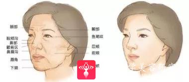 自体脂肪填充术