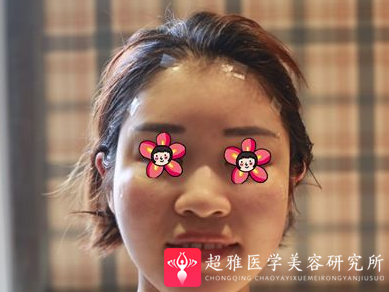 自体脂肪填充术