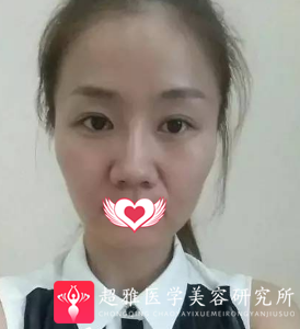 自体脂肪填充术