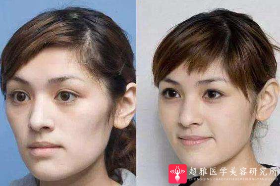 自体脂肪填充术