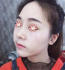 隆鼻手术