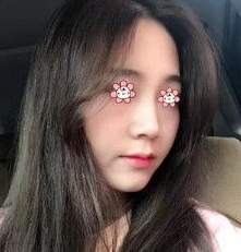 隆鼻手术