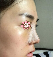 隆鼻手术