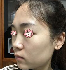 隆鼻手术