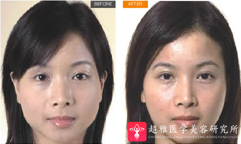 廋脸