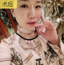 面部提升术