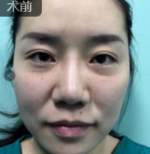 面部提升术