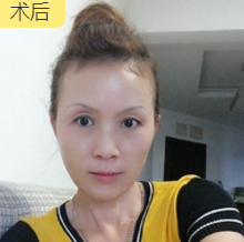 面部提升术