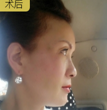面部提升术