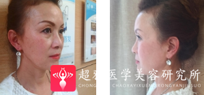 面部提升术