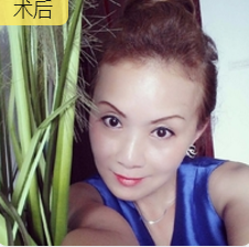面部提升术