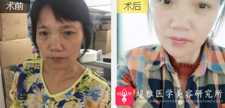 面部提升术
