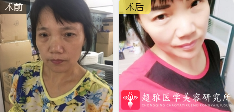 面部提升术