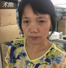 面部提升术