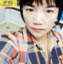 面部提升术