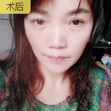 面部提升术