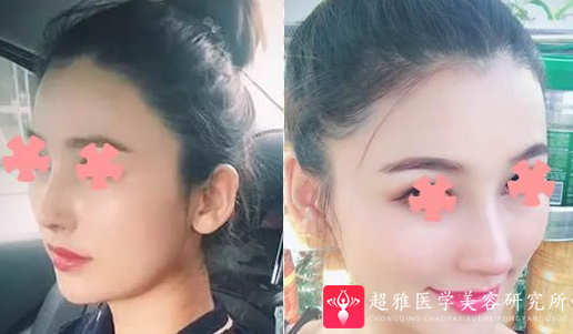 隆鼻手术