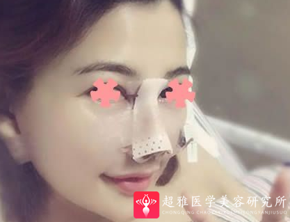 隆鼻手术