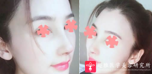 隆鼻手术
