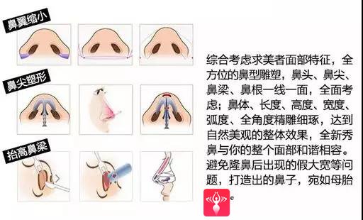 隆鼻手术
