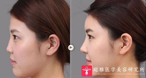 隆鼻手术