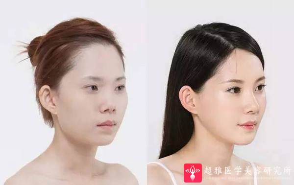 隆鼻手术