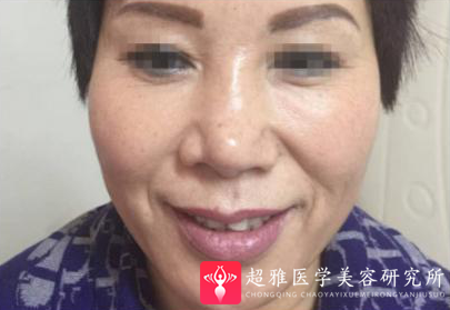 面部提升术