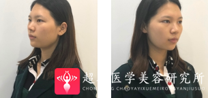 面部提升术