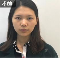 面部提升术