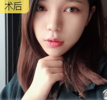 面部提升术