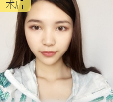 面部提升术