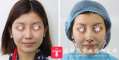 超级微拉美
