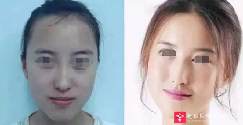 超级微拉美